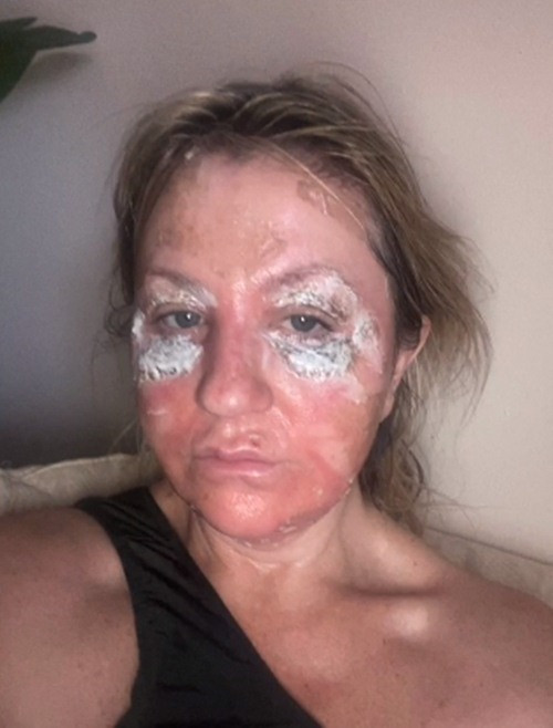 Amanda cho biết, trong thời gian hồi phục, da cực yếu nên dễ bắt nắng, hơn nữa do phải sử dụng bột khử trùng màu vàng để tránh nhiễm trùng nên Amanda quyết định ở nhà gần một tuần và nhờ con gái giúp đỡ.