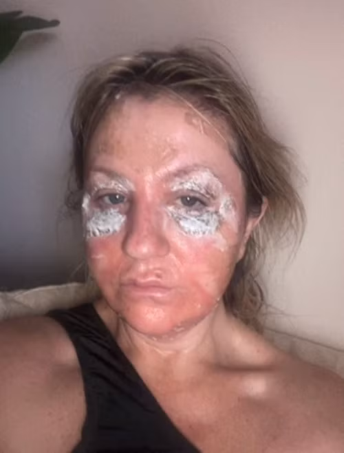 Amanda cho biết, trong thời gian hồi phục, da cực yếu nên dễ bắt nắng, hơn nữa do phải sử dụng bột khử trùng màu vàng để tránh nhiễm trùng nên Amanda quyết định ở nhà gần một tuần và nhờ con gái giúp đỡ.