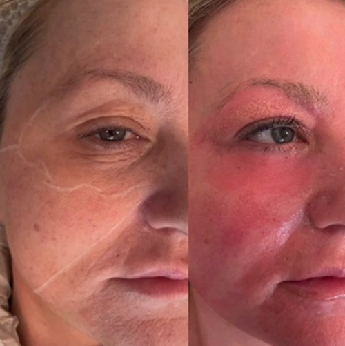 Nếp nhăn vùng mắt của cô Amanda đã hoàn toàn biến mất sau khi sử dụng liệu trình trẻ hóa da.