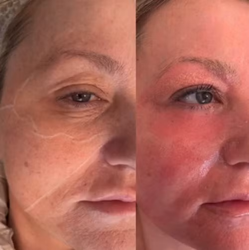 Nếp nhăn vùng mắt của cô Amanda đã hoàn toàn biến mất sau khi sử dụng liệu trình trẻ hóa da.