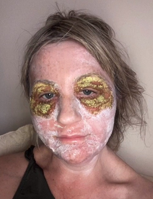 Trong quá trình điều trị, da mặt sẽ rất căng và thậm chí có cảm giác cháy nắng. Khi mới bắt đầu trị liệu, trong vài ngày, tình trạng nóng rát, bỏng cháy trên mặt ngày càng trở nên trầm trọng hơn, thậm chí mắt của Amanda bắt đầu sưng to khiến cô không thể mở mắt và không thể tự sinh hoạt được.