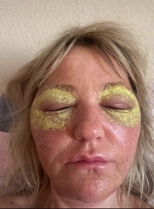 Theo The Sun, cô Amanda Watkins, 51 tuổi, sống ở Bournemouth, Anh, vốn rất chán ghét các nếp nhăn trên khuôn mặt mình. Theo Amanda, các nếp nhăn quanh mắt của cô rất rõ ràng, cô vô cùng nản lòng khi trang điểm, vì càng trang điểm lại càng già đi.