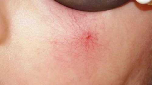 4 dau hieu xo gan, di kham ngay truoc khi qua muon-Hinh-4