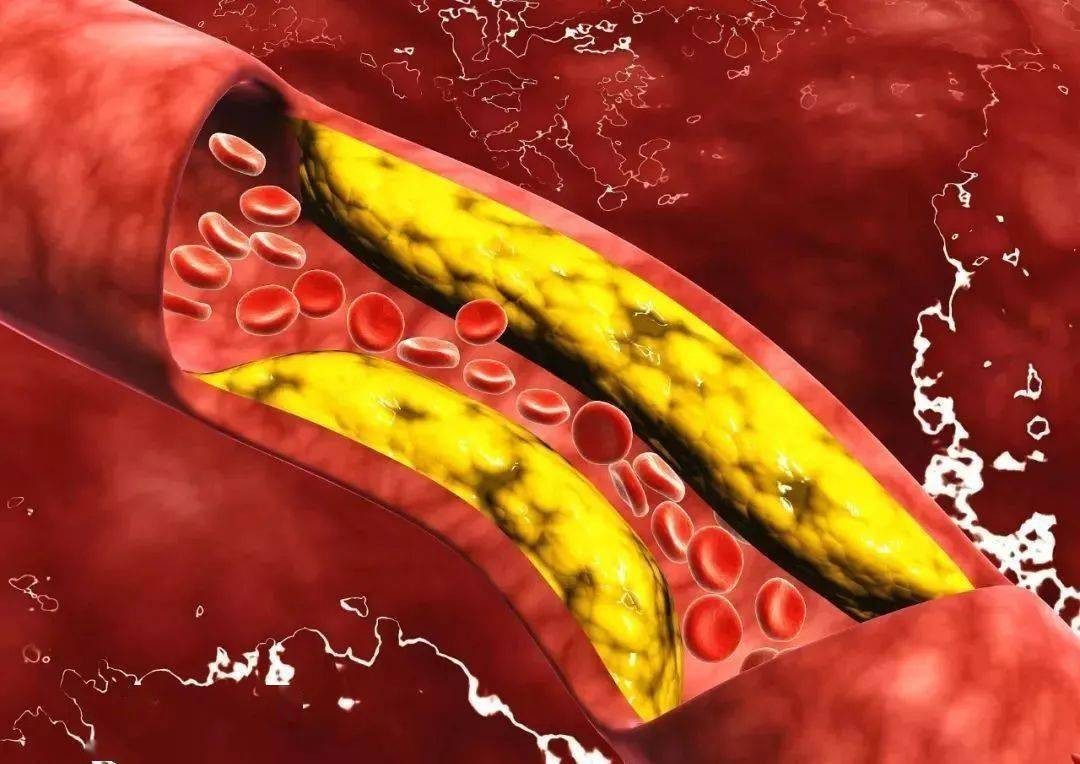 Trần Tiêu - Giám đốc Khoa não số 2 của Bệnh viện Y học Cổ truyền Tây An, Trung Quốc - nhắc nhở rằng các bệnh tim mạch và mạch máu não thường được cho là nguy hiểm nhất vào mùa đông. Tuy nhiên, mùa hè nắng nóng cũng dễ dẫn đến tim mạch và mạch máu não, nhất là khi nhiệt độ vượt quá 35 ℃, mạch máu giãn ra, lượng máu lưu thông sẽ nhanh gấp 3-5 lần bình thường, lượng máu về tim tăng lên, nhịp tim tăng tốc, động mạch vành dễ co lại, khối lượng công việc của tim lớn gấp mấy lần bình thường.