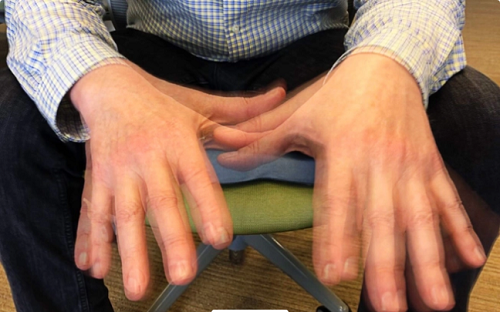  Chuột rút: Chuột rút là một trong những dấu hiệu suy thận cần chú ý. Tình trạng này bắt nguồn từ việc mất cân bằng nồng độ natri, canxi, kali làm gián đoạn hoạt động của cơ và dây thần kinh.