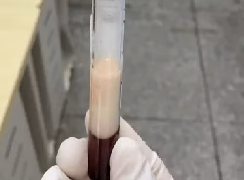 Mac viem tuy cap, nguoi dan ong co mau dac nhu sua