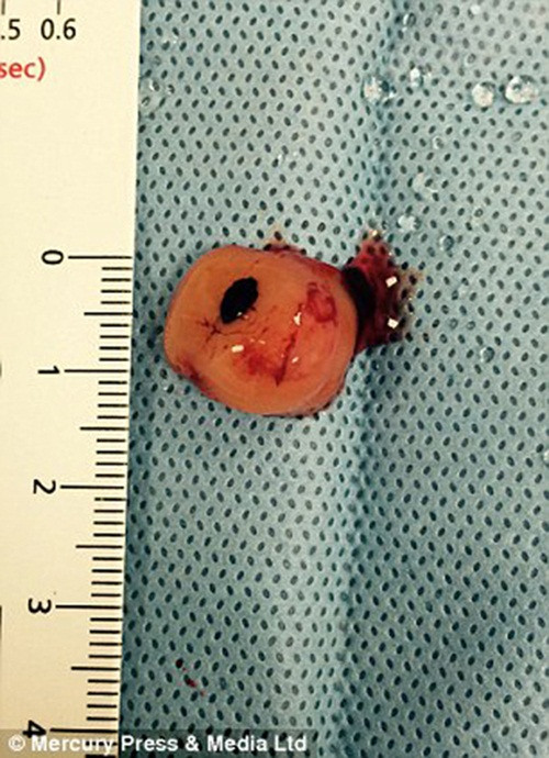 Khối u được lấy ra từ con cá vàng.