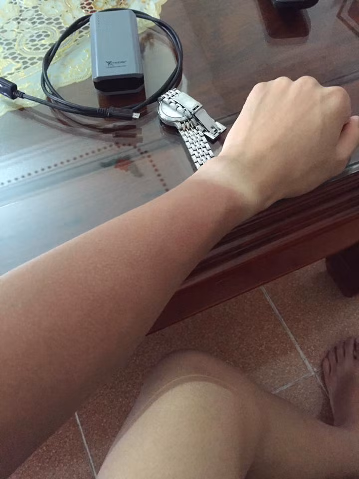 Với những người "dữ da", cái nắng những ngày vừa qua còn khiến làn da của họ bị bong tróc, ngứa ngáy rất khó chịu. Những bí kíp chống nắng hay phục hồi làn da cháy nắng, bị hư tổn cũng được dân mạng share nhiệt tình trong suốt những ngày vừa qua.