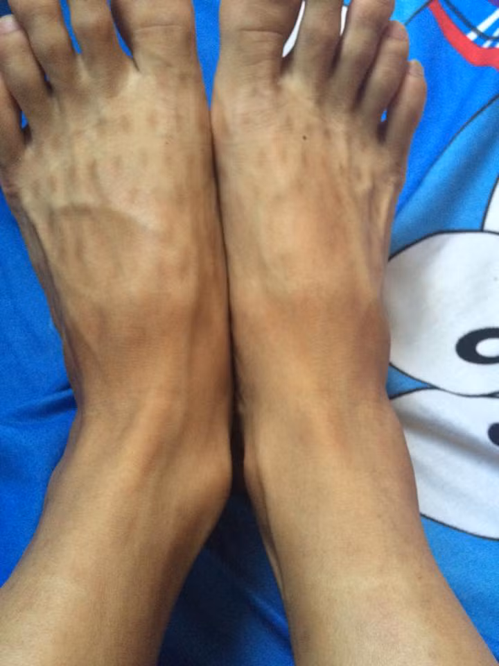 Và khi da bị cháy nắng, bong tróc thì chanh và sữa chua là hai thứ có thể giúp mọi người cảm thấy dễ chịu, bớt ngứa ngáy hoặc đau ra hơn. Chỉ cần bôi một lượng nhỏ chanh hoặc sữa chua lên vùng da bị cháy bong tróc sau đó tắm sạch, hiệu quả sẽ thấy rõ.