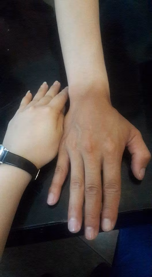 Những bức ảnh so sánh làn da trước và sau mùa hè, vùng tiếp xúc với ánh nắng và vùng được che chắn... được rất nhiều dân mạng, các bạn trẻ chia sẻ lên Facebook những ngày này. Với những cô gái vốn coi làn da đen là nỗi ám ảnh thì trong những ngày này, họ hầu như chỉ muốn trốn trong phòng điều hòa mà bất đắc dĩ mới phải ra ngoài.