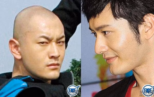 Soi nhan sac cac “nam than” truoc khi phau thuat tham mi-Hinh-2