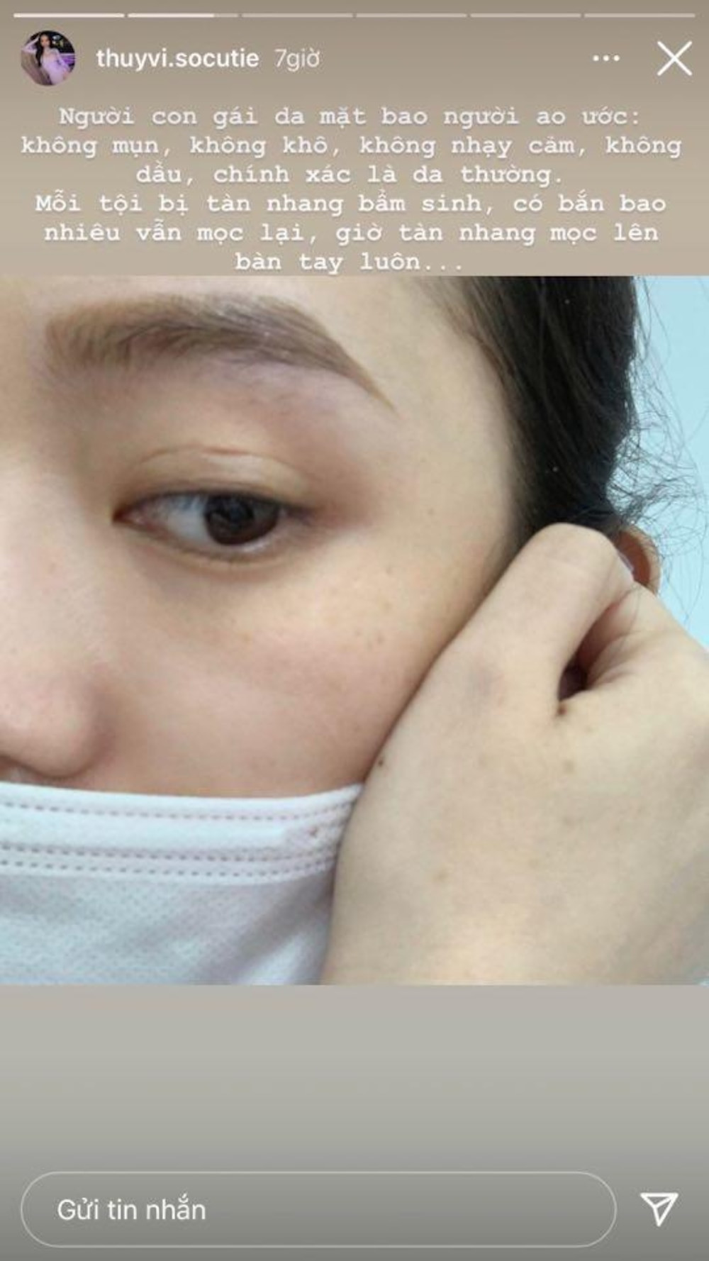 Từng chi tiền tỷ phẫu thuật thẩm mỹ thế nhưng người đẹp thị phi này vẫn không thể sửa được một khuyết điểm trên gương mặt của mình, đó chính là tàn nhang. Thúy Vi chia sẻ lên trang cá nhân hình ảnh chụp cận mặt thấy rõ những đốm tàn nhang của việc tuổi tác.