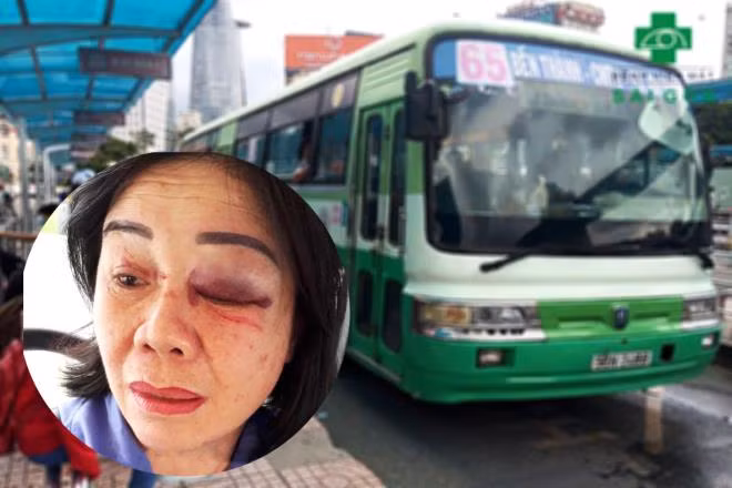  3. Nhắc khách mở nhạc nhỏ bị đấm sưng mặt: Ngày 4/8, bà Oanh làm công việc tiếp viên trên xe buýt số 65 nhắc một hành khách nam mở nhỏ nhạc khi đang ở trên xe bus nên xảy ra cự cãi. Hành khách này khó chịu nên đã lao vào hành hung bà Oanh thâm tím vùng mắt. Khi xe dừng, cửa mở người này bỏ đi mất.