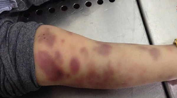 Ngày 12/12/2021, lúc 16h27 phút, Trang bắt cháu A quỳ gối, giơ hai tay lên cao, dùng thanh kim loại có đầu nhựa đánh và dùng chân đạp vào người bắt cháu A. chui vào chuồng chó, nhốt cùng với chó, vừa chửi mắng vừa dùng tay tát vào mặt, nằm tóc, kéo tai cháu A. Thái cầm thanh kim loại có đầu nhựa đứng bên cạnh chứng kiến. Đến 17h, Trang bắt cháu A. ra khỏi chuồng chó cởi quần nằm sấp để Trang sử dụng cây gỗ đánh và cùng với Thái tra khảo bài. 