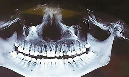 Bỗng dưng ăn thấy đau, đi khám thấy răng mọc gần mắt Bong dung an thay dau, di kham thay rang moc gan mat