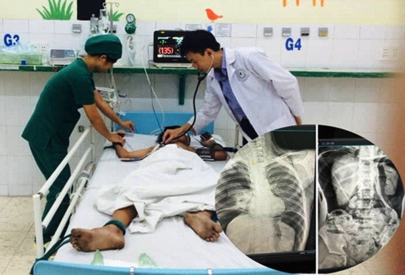 Be trai vo dai trang, nguy kich vi ban bom hoi vao hau mon