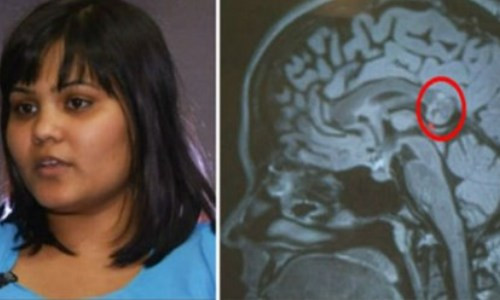 Ta hoa phat hien nguoi mang “phoi thai” trong... nao