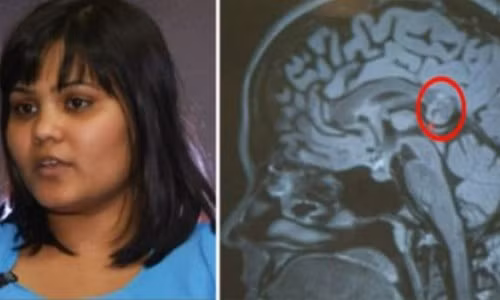 Ta hoa phat hien nguoi mang “phoi thai” trong... nao