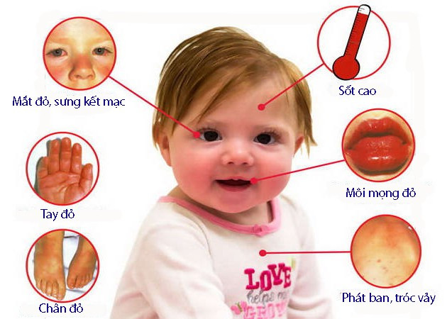 Tre ho sot dung coi thuong dau hieu benh la nguy hiem Kawasaki