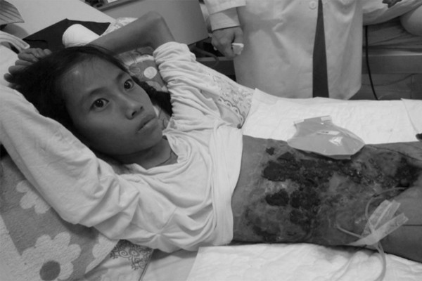 Cô gái mất toàn bộ thành bụng, dùng vải che nội tạng sống sót diệu kỳ Co gai mat toan bo thanh bung, dung vai che noi tang song sot dieu ky