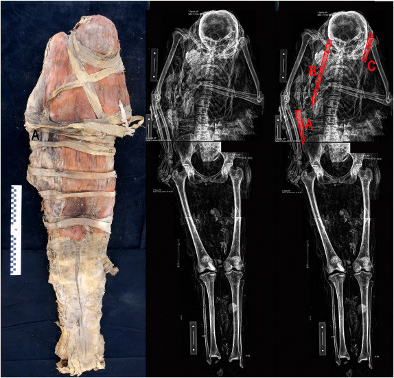 Cụ thể, khi chụp X-quang xác ướp người phụ nữ Ai Cập trên, các chuyên gia tại Đại học New Jersey (Mỹ), Đại học Alacá (Tây Ban Nha) và Đại học Mỹ ở Cairo, Ai Cập phát hiện một bí mật lớn.
