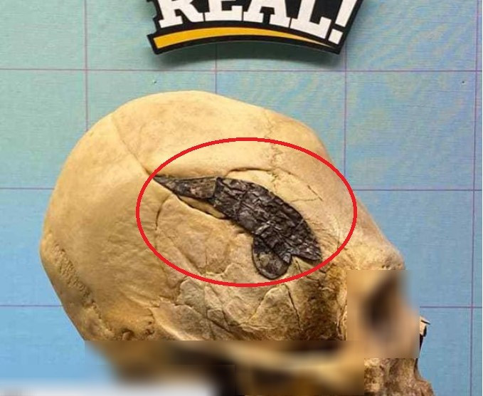 Bảo tàng Xương học Oklahoma ở Mỹ lưu giữ một hộp sọ bí ẩn. Trong suốt nhiều năm, các chuyên gia nỗ lực giải mã hộp sọ bị kéo dài giống như người ngoài hành tinh trong các bộ phim. Không những vậy, một mảng sọ được thay thế bằng miếng kim loại lớn.