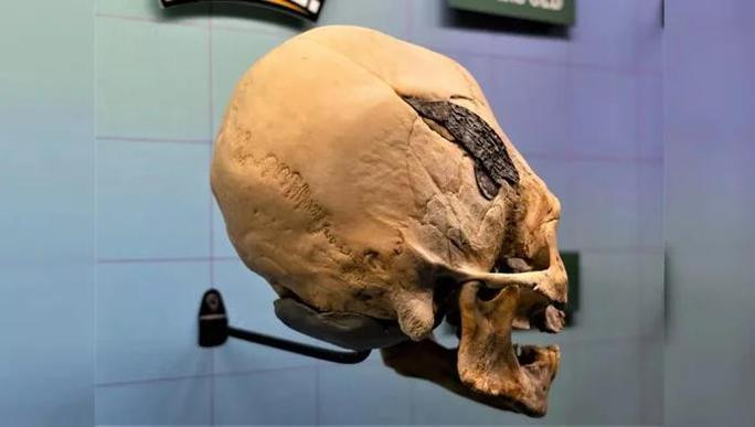 Tuy nhiên, các nhà nghiên cứu hiện chưa thể lý giải vì sao mảnh kim loại lại được ghép vào hộp sọ. Từ đây, một giả thuyết được đưa ra để lý giải nguồn gốc mảnh ghép kim loại trên. Nó được cho có thể là một thủ thuật y tế nhằm "vá lỗ thủng", được tạo ra sau quá trình trepanation (thuật ngữ dùng để chỉ dạng phẫu thuật cổ xưa).