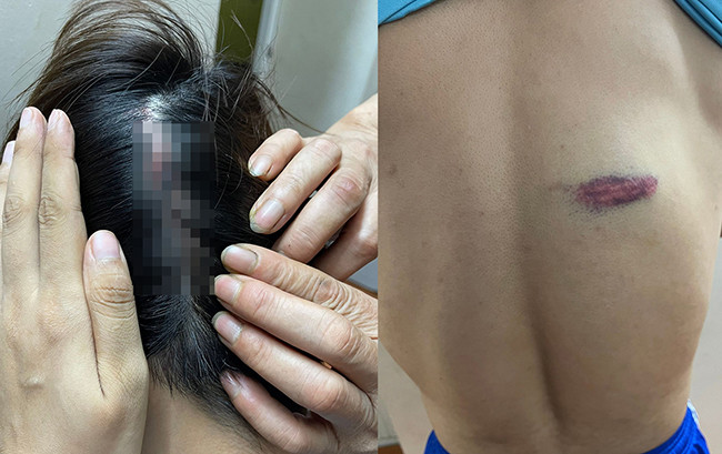 Ha Noi: Kiem thu Nguyen Van Quyet bi dong doi hanh hung nhap vien