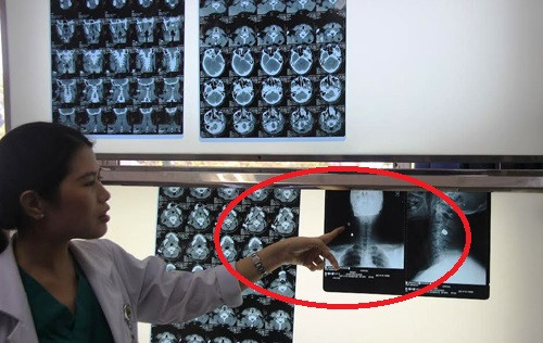 Viên đạn đã được các bác sĩ gắp ra khỏi cơ thể nạn nhân.