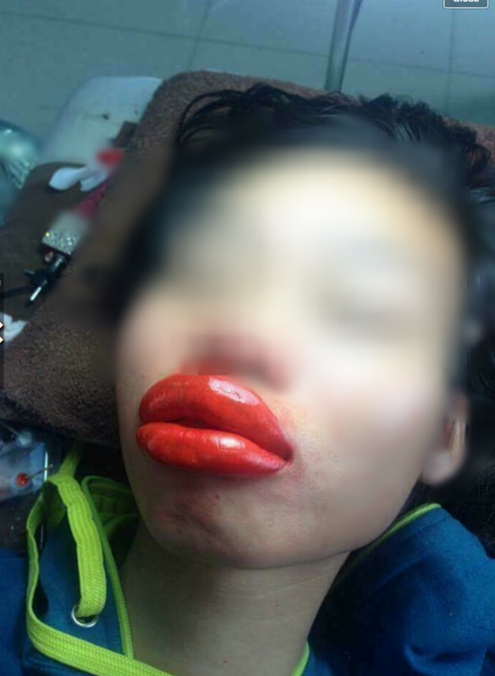 Phần đông cư dân mạng đã giải thích một cách hài hước cho sản phẩm lỗi này là do cô nàng bị “nghiệp tụ vành môi” hay chỉ đơn thuần là đi “giải khẩu nghiệp mà không thành”.