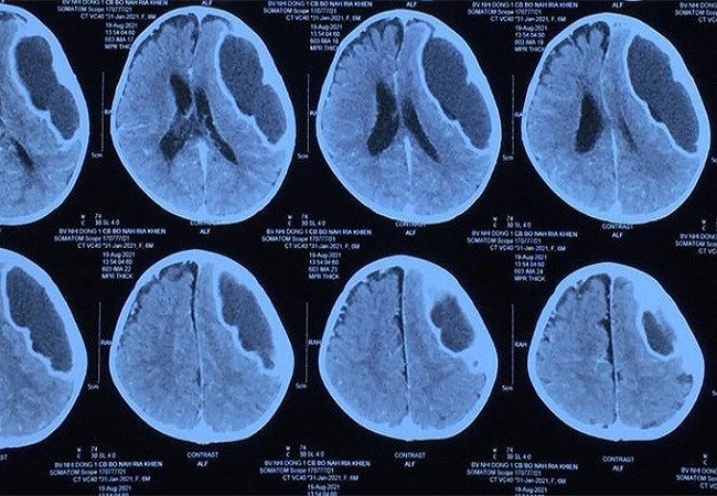 Den vien muon, be 8 thang tuoi bi ap xe trong nao day nhu vo cam sanh