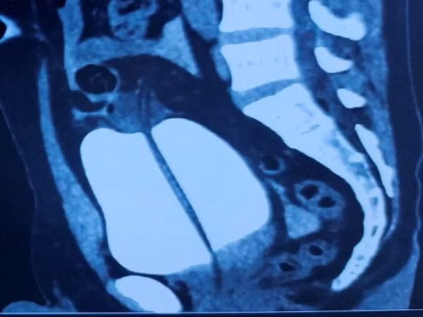 Hi hữu: Nam thanh niên nhập viện vì... vỡ bàng quang sau cuộc nhậu Hi huu: Nam thanh nien nhap vien vi... vo bang quang sau cuoc nhau