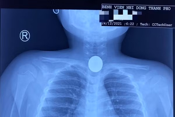 Cuu song be 5 tuoi nuot dong xu vao co hong