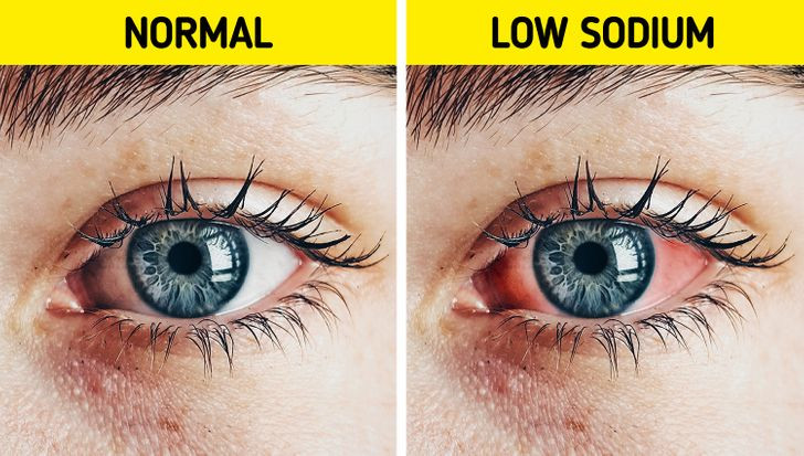 1. Mồ hôi mặn: Cũng giống như nước mắt, mồ hôi có vị mặn là điều bình thường. Tuy nhiên, nếu nó mặn bất thường đến mức làm bỏng mắt bạn và làm vết cắt hở ra, thì đây là dấu hiệu cơ thể bạn có thể đang thiếu natri. Ảnh: BS.