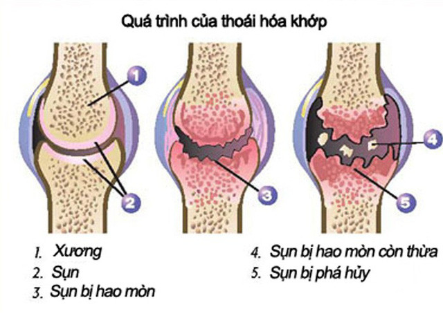 Canh bao benh thoai hoa khop o nguoi tre, cach nao de phong ngua?-Hinh-3