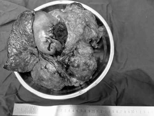 Tuong dau bung vi da day ai ngo phat hien u gan “khung“