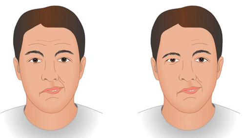 2. Vấn đề ngôn ngữ. Xuất hiện tình trạng nhồi máu não nhẹ, người bệnh có thể có các vấn đề về ngôn ngữ như nói năng kém lưu loát, nói ngọng, diễn đạt không trôi chảy, khóe miệng hơi cong, chảy dãi liên tục...