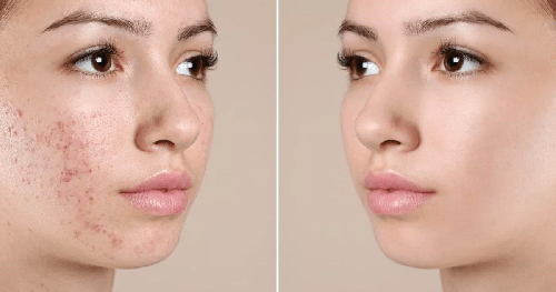 Kiểm soát mụn trứng cá. Nước muối có tác dụng kháng viêm, khử trùng, diệt khuẩn nên có thể ngăn ngừa vi khuẩn, bụi bẩn thâm nhập nang lông. Nhờ vậy, tránh được tình trạng viêm da, mọc mụn, giúp da ngày càng mịn màng.