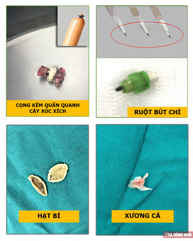 Tre tu vong do hoc di vat la cong kem o dau cay xuc xich