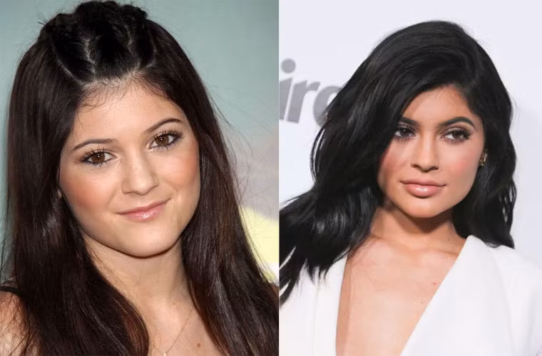 Khuôn mặt lúc còn niên thiếu của người mẫu Kylie Jenner (trái) và hiện tại đã khác nhau rất nhiều nhờ trang điểm và phẫu thuật thẩm mỹ.