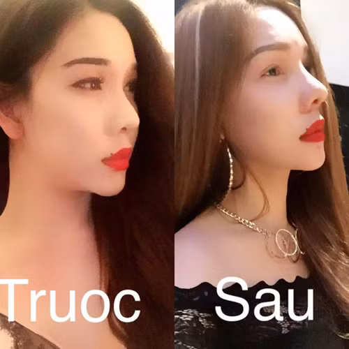 Quả thật, xem những bức ảnh mới của Hoàng My, có thể thấy tuy chiếc mũi của cô đã cao hơn đáng kể nhưng nhìn tổng thể khuôn mặt đã mất đi sự tự nhiên. Khuôn mặt cô người mẫu chuyển giới nay nhìn khá cứng, thậm chí là hơi... giả.