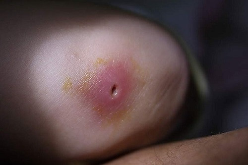 Lấy hoa chuối tươi rửa sạch, giã nát với vài hạt muối sau đó đắp lên vết mụn nhọt cũng làm dịu đau nhức giảm tổn thương.