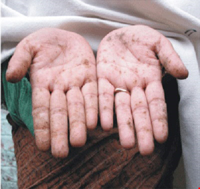 Tuy nhiên, nếu bạn liên tục sử dụng thực phẩm, nguồn nước hay hít vào không khí nhiễm chì trong thời gian dài thì sẽ bị ngộ độc chì nguy hiểm. Ảnh: Sống khỏe.