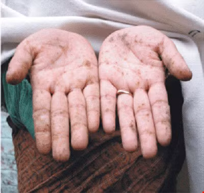 Tuy nhiên, nếu bạn liên tục sử dụng thực phẩm, nguồn nước hay hít vào không khí nhiễm chì trong thời gian dài thì sẽ bị ngộ độc chì nguy hiểm. Ảnh: Sống khỏe.