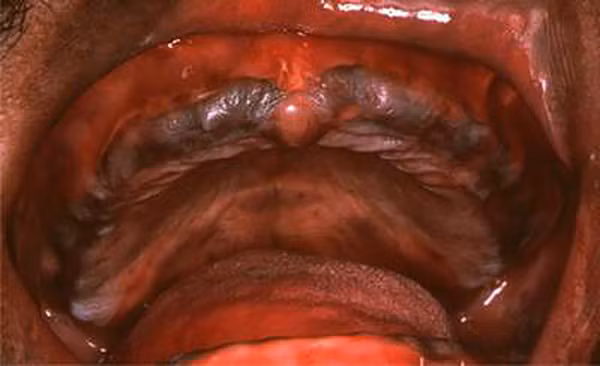 Bạn có thể bị ngộ độc chì khi sử dụng nước, thức ăn, thực phẩm có nhiễm chì vào cơ thể. Nếu lượng chì nhiễm vào cơ thể với lượng nhỏ trong ngưỡng quy định thì không gây hại bởi nó có thể được đào thải qua nước tiểu, mồ hôi. Ảnh: Benhvn.