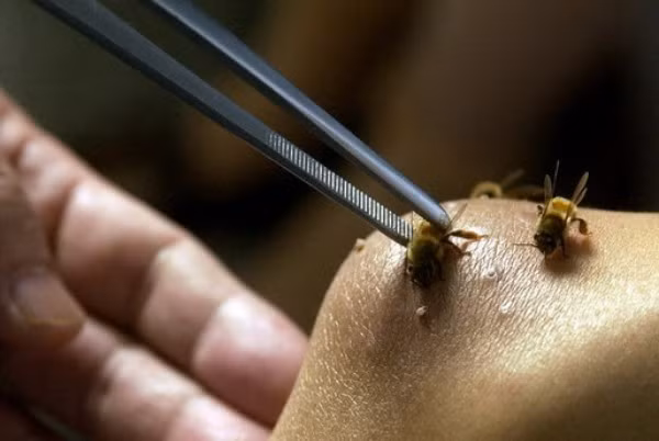 Khi bị rắn cắn hoặc ong đốt có thể lấy lá khoai sọ giã nát đắp vào vết đốt cũng giảm đau hút bớt độc tố ra ngoài. (Thông tin trong bài chỉ mang tính chất tham khảo, vui lòng hỏi ý kiến bác sĩ khi sử dụng.) Nguồn ảnh: Y học cổ truyền, Getty.