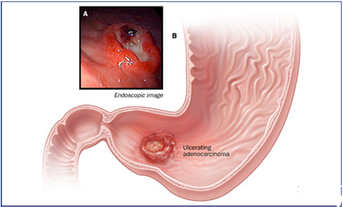 Bệnh xuất huyết dạ dày có thể là hậu quả của những tổn thương lâu dài do bạn bị viêm loét dạ dày cấp tính hoặc mãn tính gây ra. Nếu tình trạng viêm loét không được phát hiện sớm và chữa trị kịp thời thì sẽ gây ra chảy máu dạ dày.
