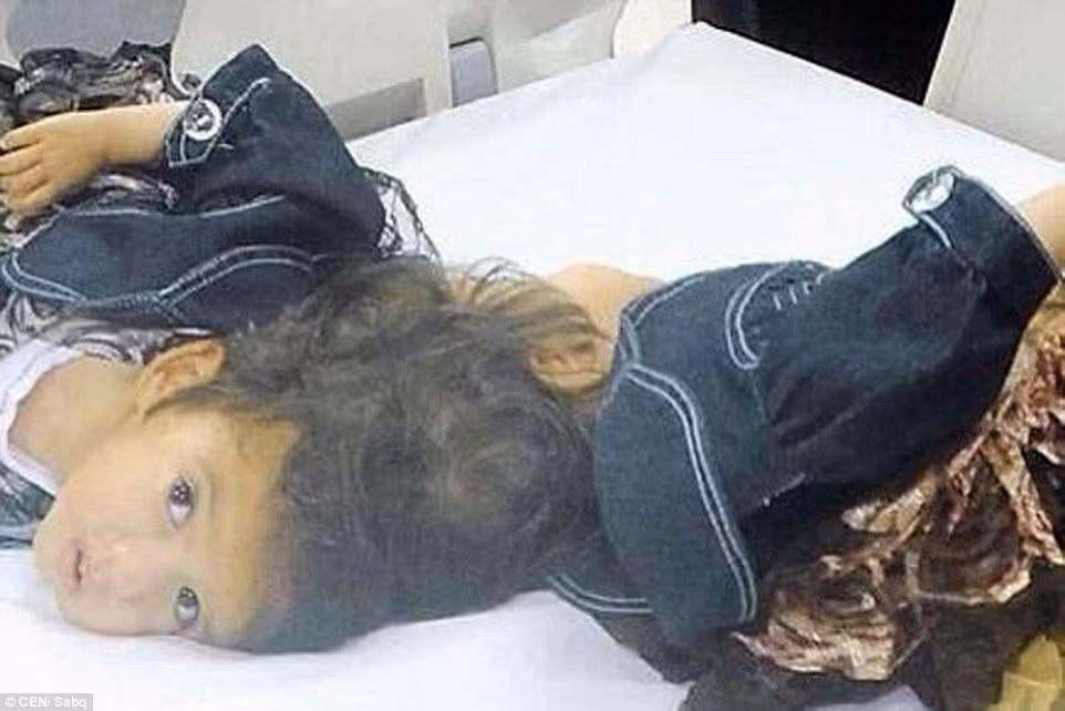 Trong số những cặp đôi được sinh ra, khoảng 60% chết vài giờ sau khi sinh.