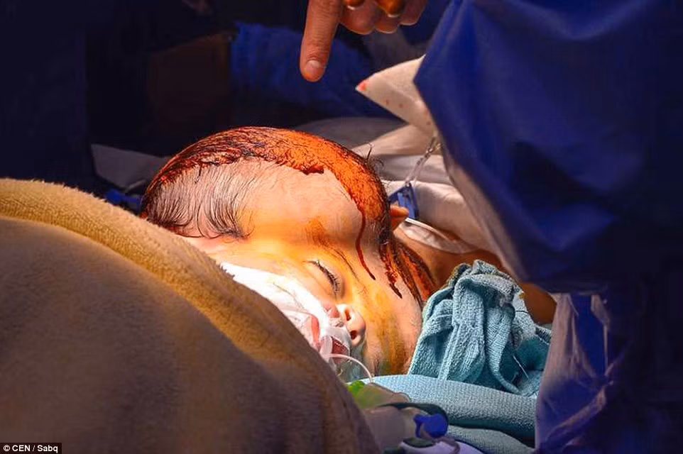 Tham gia ca phẫu thuật này có tới 22 bác sĩ và nhân viên y tế. Tiến sĩ Ahmad Al-Furrayan, bác sĩ phẫu thuật chính cho biết ca phẫu thuật đã thành công ngoài mong đợi và chỉ kéo dài 10 giờ thay vì 12 giờ như dự kiến ban đầu.