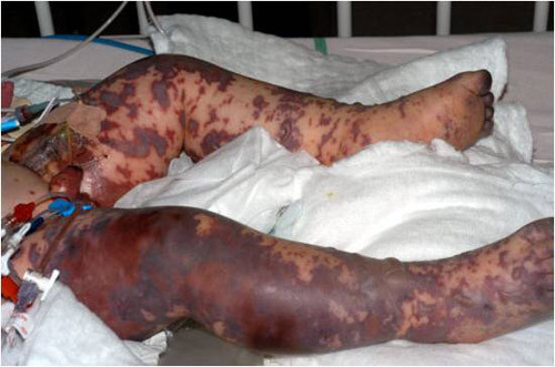 Bệnh cũng có thể lây gián tiếp qua tiếp xúc trên da hay qua đồ dùng, dụng cụ hàng ngày như ly, tách, điện thoại. Tuy nhiên, những vi khuẩn này không phải là truyền nhiễm như vi khuẩn gây cảm lạnh hay cảm cúm, tức là không lây qua tiếp xúc thông thường hoặc bằng cách hít thở không khí.